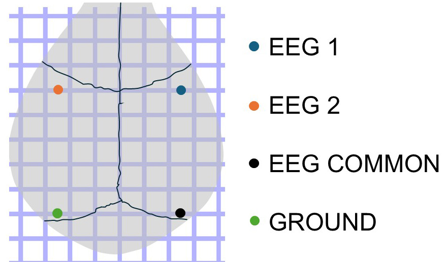 Needle Implant Configuration 1