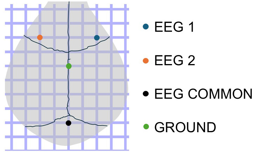 Needle Implant Configuration 3
