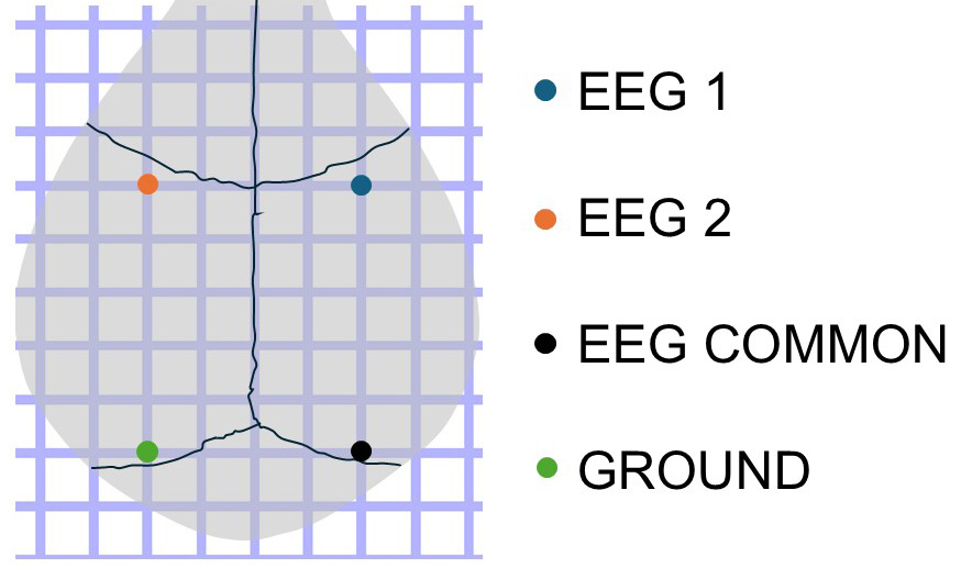 Needle Implant Configuration 2